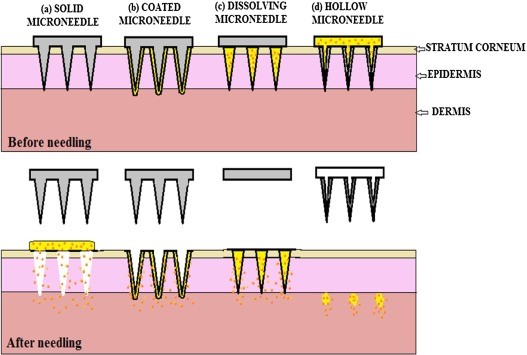 Microneedles: An Intelligent Technology